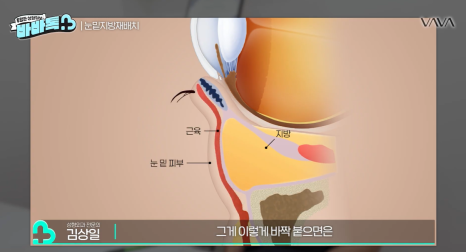 눈밑지방재배치 vs 하안검 vs 필러, 나는 어떤 케이스일까? | 압구정 바바성형외과에서 알려드립니다 관련 이미지 23