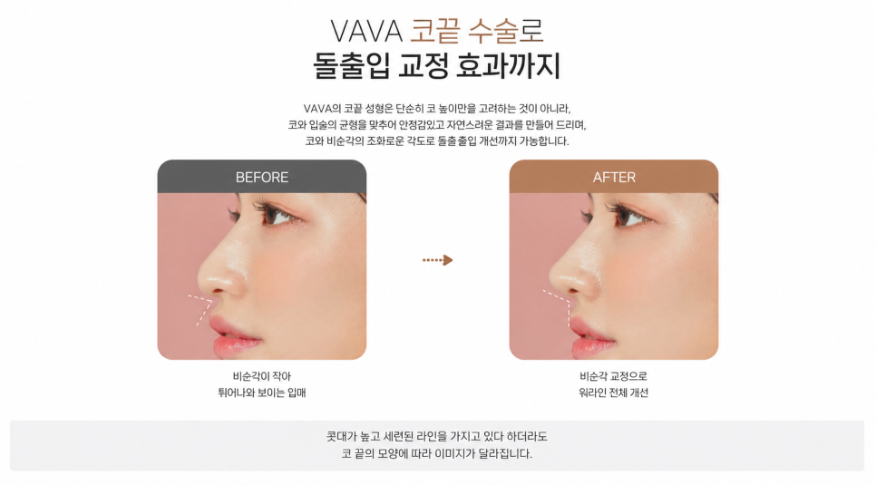 The Secret to a Refined Nose Line Lies in the Tip | BABA Plastic Surgery Tip Plasty image 10