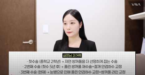 바바성형외과 절개 쌍수 절개 눈매교정 쌍꺼풀  재수술  사례 관련 이미지 2