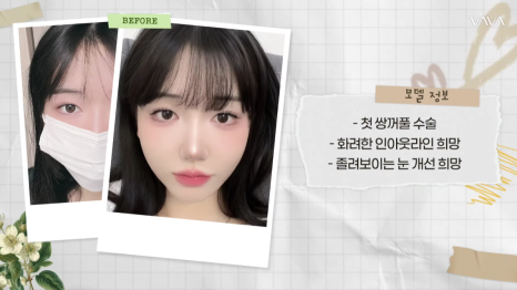 졸려보이는 눈 자연유착 밑트임 위트임으로 또렷하게 (리얼 후기) 관련 이미지 3