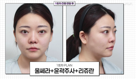 결혼식 전, 더 예쁜 나를 위한 작은 준비 (웨딩 시술 리얼 후기) 관련 이미지 14