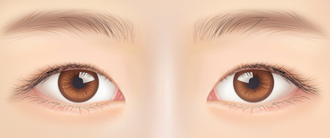 자연유착 VS 절개  어떤 기준으로 선택해야 할까? 관련 이미지 13