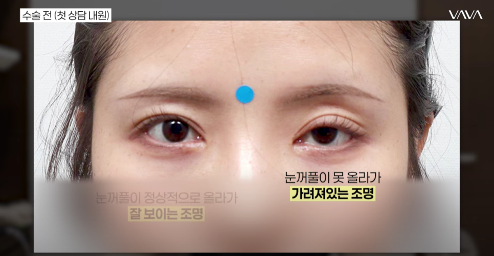 쌍수 후 생겨버린 짝눈 교정 눈의 균형을 맞추는 섬세한 방식 관련 이미지 12