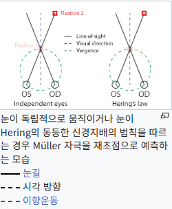 쌍수 후 생겨버린 짝눈 교정 눈의 균형을 맞추는 섬세한 방식 관련 이미지 7
