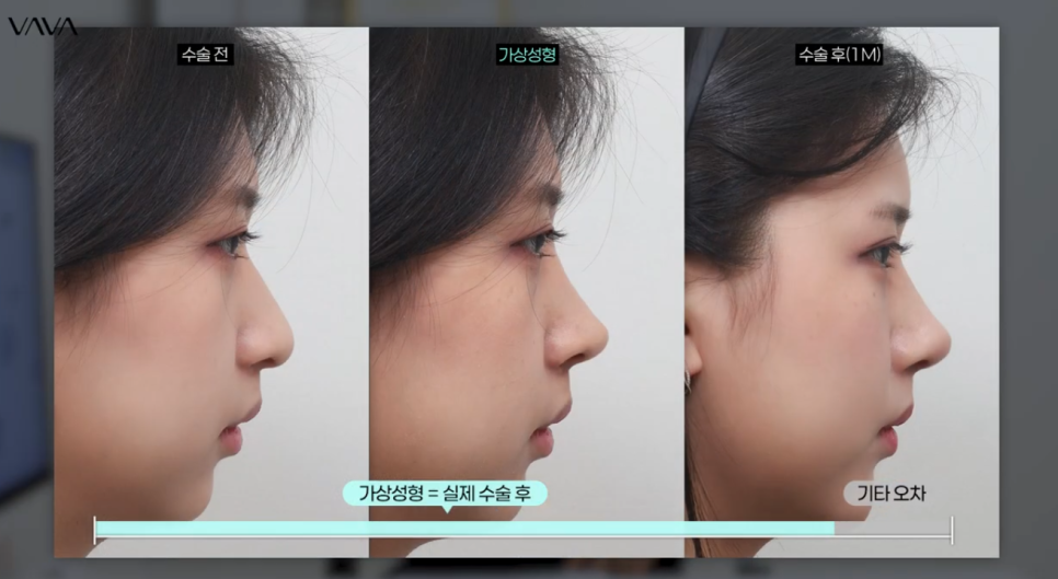 코수술 전 포토샵으로 결과를 확인하는 이유 ㅣ 바바성형외과 코수술 가상성형 상담 관련 이미지 11