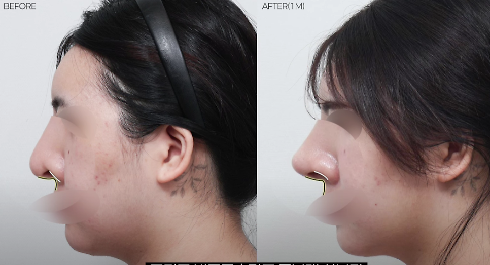 예쁜 코의 공통점은? 성형외과 원장이 알려주는 코 성형 성공하는 방법(리얼 후기 케이스) 관련 이미지 25