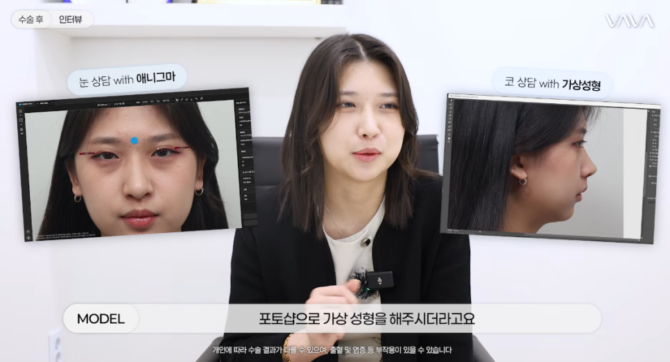 눈이랑 코 같이 하면 더 예뻐질까? ㅣ  동시성형 솔직 정리 관련 이미지 7