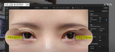 쌍수 후 생겨버린 짝눈 교정 눈의 균형을 맞추는 섬세한 방식 관련 이미지 18