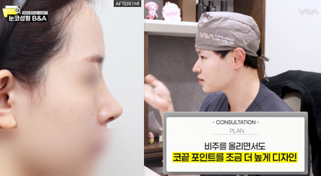 복코 매부리코 긴코 교정 ㅣ 코성형 전후 케이스 (NJZ민지 코) 관련 이미지 21