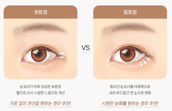 Concerned About Eyes That Look Narrow and Constricted? | When a Lateral Canthoplasty & Lower Canthoplasty May Be Needed at Baba Plastic Surgery Clinic image 2