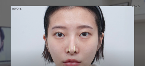 코재수술 원인, 과연 코끝처짐만이 문제일까? 가장 이상적인 라인 알려드립니다 관련 이미지 15