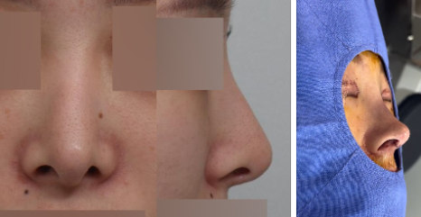 코성형 재수술, 처음보다 더 어려운 이유는? 성공하려면 이것부터! 관련 이미지 7