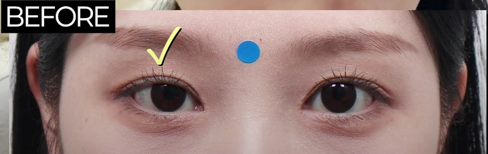 바바성형외과 절개 쌍수 절개 눈매교정 쌍꺼풀  재수술  사례 관련 이미지 3