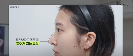 코재수술 원인, 과연 코끝처짐만이 문제일까? 가장 이상적인 라인 알려드립니다 관련 이미지 22