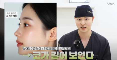 화려한 코성형, 높이만이 답일까?｜압구정 바바성형외과 코성형 꿀팁 관련 이미지 6