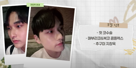 남자 코성형 리얼 후기 한 달 차 사례 비교해 보며 분석하기 관련 이미지 2