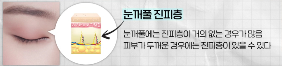 나에게 맞는 쌍꺼풀 수술법 총정리 : 절개, 부분절개, 매몰법까지 관련 이미지 9