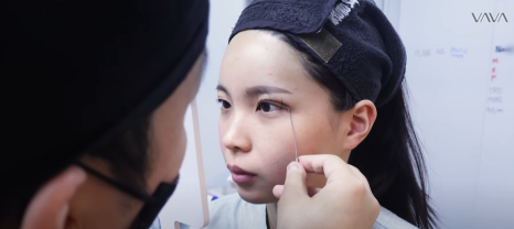 쌍수 재수술 성공기 ｜ 졸려보이는 눈 세미아웃으로 예뻐진 리얼 Before & After 관련 이미지 6