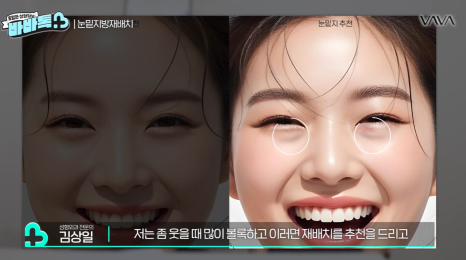 눈밑지방재배치 vs 하안검 vs 필러, 나는 어떤 케이스일까? | 압구정 바바성형외과에서 알려드립니다 관련 이미지 6