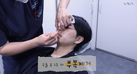 눈&middot;구축코 재수술 후기｜남자 눈코 재수술, 압구정 바바에서 달라진 이유 관련 이미지 17