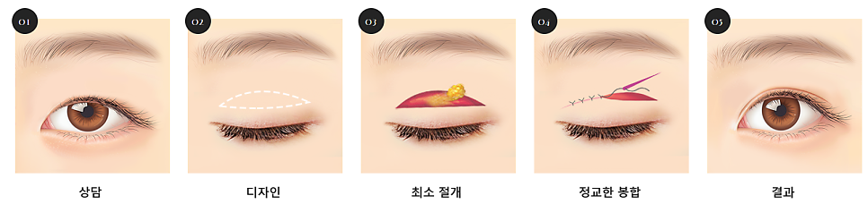 쌍꺼풀 수술 종류 비절개 vs 절개 vs 부분 절개 관련 이미지 2