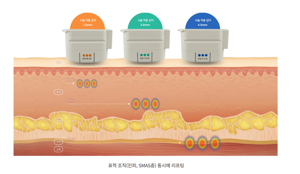 울쎄라 효과 언제부터? 윤곽까지 바뀌는 리프팅, 압구정 바바성형외과(리얼후기) 관련 이미지 11