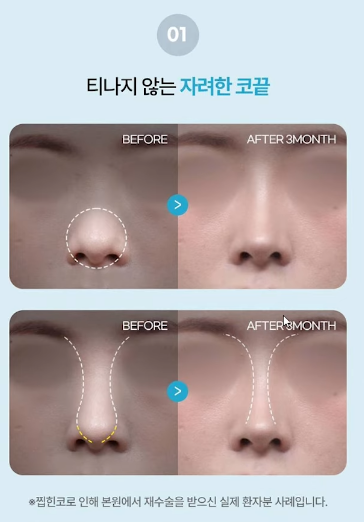 압구정 바바성형외과 코성형 &ndash; 정면&middot;측면 모두 고려한 코라인 설계 관련 이미지 10