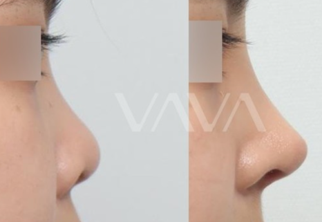 코성형 재수술, 처음보다 더 어려운 이유는? 성공하려면 이것부터! 관련 이미지 5