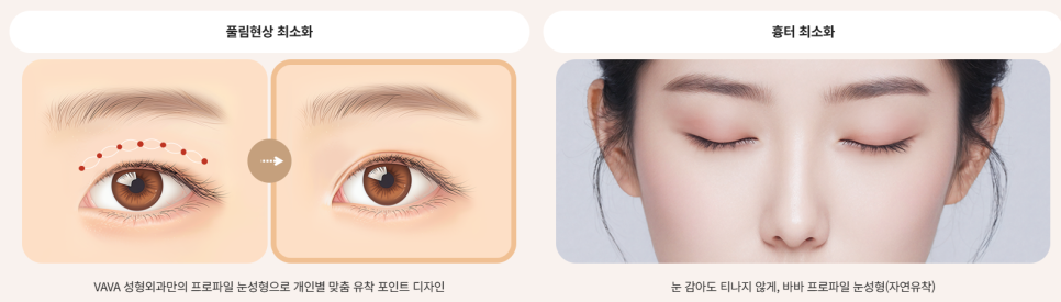 여름철 휴가 전 쌍꺼풀 수술 붓기 관리와 회복 TIP 관련 이미지 2