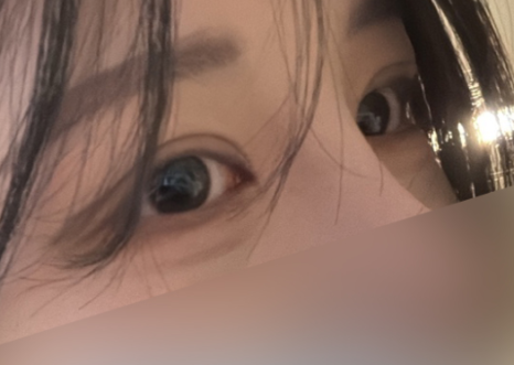 여름철 휴가 전 쌍꺼풀 수술 붓기 관리와 회복 TIP 관련 이미지 11