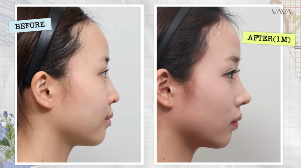 코재수술로 인상까지 달라질 수 있을까?｜바바성형외과 직반라인 코재수술 후기 관련 이미지 1