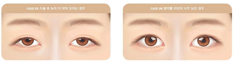 눈 재수술로 보다 완벽한 눈매라인 되찾기 관련 이미지 4