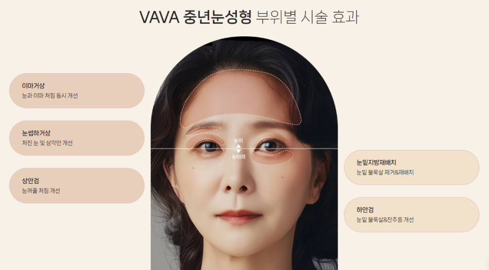 중년눈수술 필요한 시기? 눈꺼풀처짐 증상과 개선 방법 ㅣ 바바성형외과 중년눈수술 관련 이미지 10