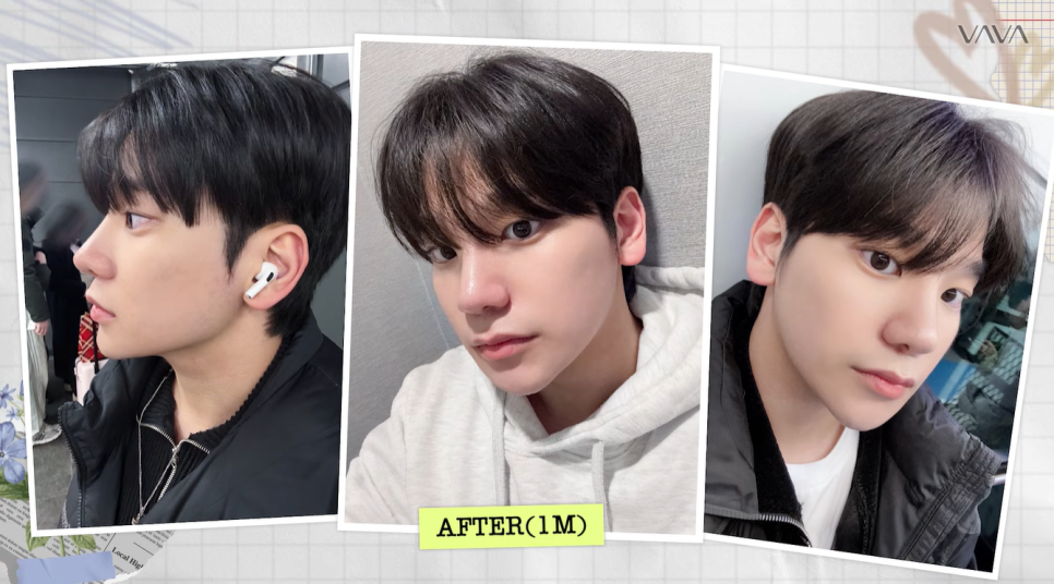 무보형물 직선라인 코성형으로 주먹코&middot;복코 개선｜압구정 바바성형외과 사례 관련 이미지 24