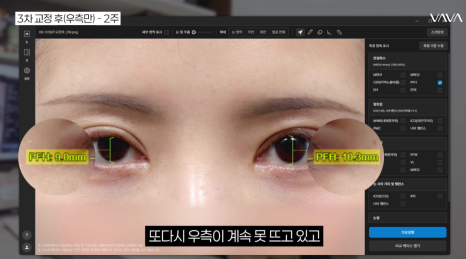 쌍수 후 생겨버린 짝눈 교정 눈의 균형을 맞추는 섬세한 방식 관련 이미지 19