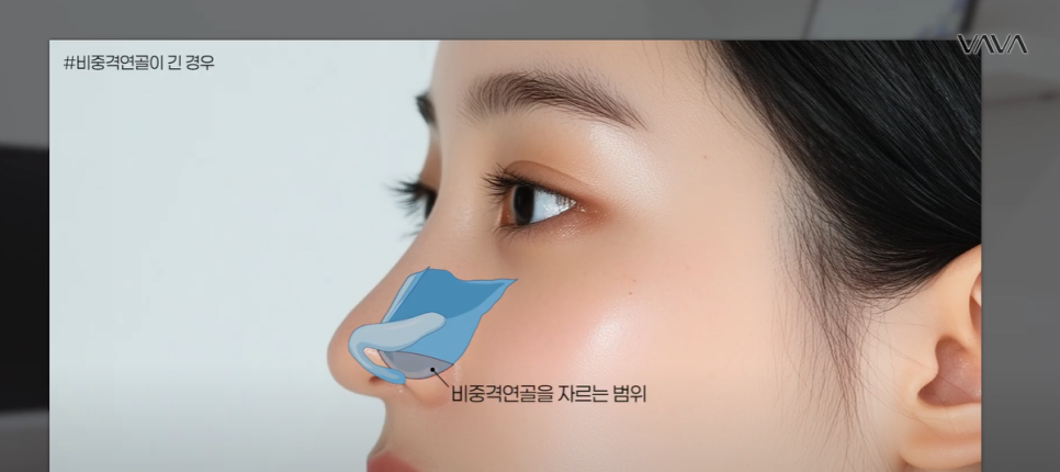 압구정 바바성형외과 | 코성형의 핵심, 비주의 중요성과 교정 방법 관련 이미지 10