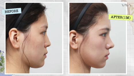 보형물 없이 선명하게｜바바성형외과 무보형물 매부리코 교정 리얼 후기 관련 이미지 24