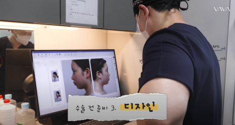 바바성형외과 눈&middot;코 성형 한 달 차 리얼 케이스 (윈터, 카리나 코) 관련 이미지 9