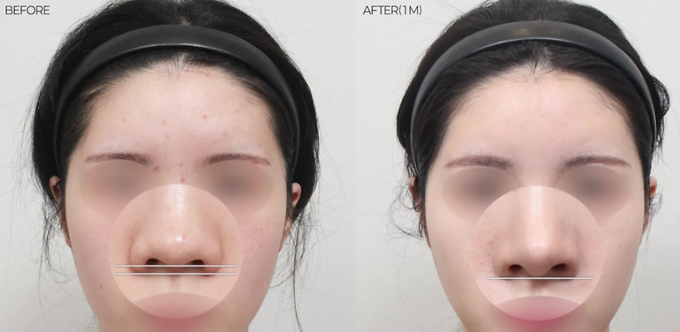 예쁜 코의 공통점은? 성형외과 원장이 알려주는 코 성형 성공하는 방법(리얼 후기 케이스) 관련 이미지 19