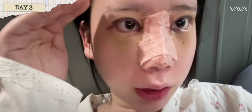 바바성형외과 눈&middot;코 성형 한 달 차 리얼 케이스 (윈터, 카리나 코) 관련 이미지 11