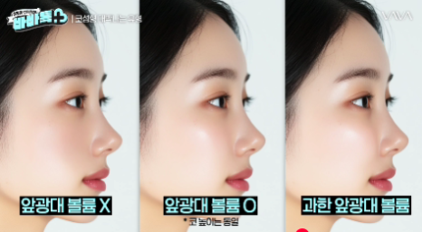 코 수술 성공을 위한 유형과 조건 확인 해보기 관련 이미지 14