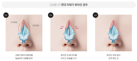 복코, 매부리코, 낮은코 | 바바성형외과 유형별 코성형, 내 코에 맞는 방향 찾기 관련 이미지 16