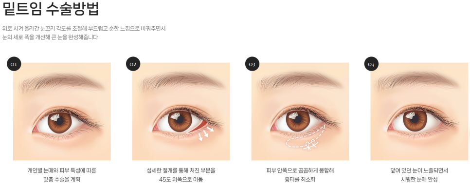 Concerned About Eyes That Look Narrow and Constricted? | When a Lateral Canthoplasty & Lower Canthoplasty May Be Needed at Baba Plastic Surgery Clinic image 4