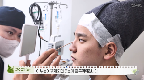 무보형물 직선라인 코성형으로 주먹코&middot;복코 개선｜압구정 바바성형외과 사례 관련 이미지 8