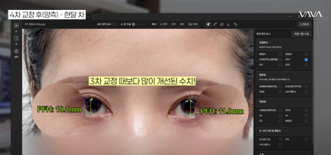 쌍수 후 생겨버린 짝눈 교정 눈의 균형을 맞추는 섬세한 방식 관련 이미지 21