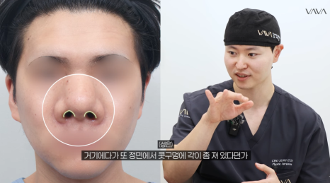 첫 코 성형, 언제&middot;어떻게 해야 할지 기준 정리해드립니다 관련 이미지 33