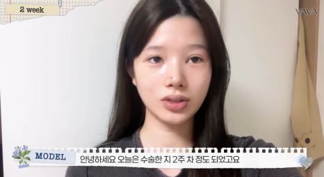 압구정 바바성형외과 자가늑 코성형 후기｜복코&middot;매부리코 교정 한달차 변화 관련 이미지 16