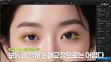 쌍수 후 생겨버린 짝눈 교정 눈의 균형을 맞추는 섬세한 방식 관련 이미지 5