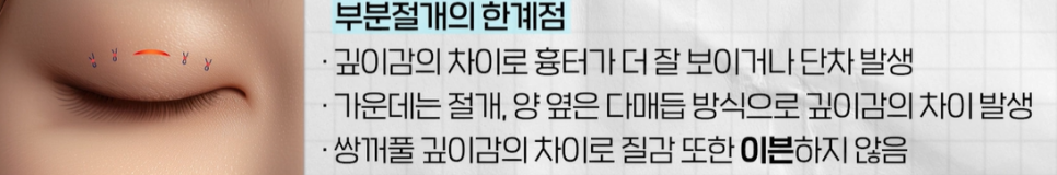 쌍꺼풀 수술 짧은 회복기 가능? 종류별 차이 완전 정리 관련 이미지 9