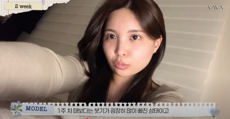 쌍수 재수술 성공기 ｜ 졸려보이는 눈 세미아웃으로 예뻐진 리얼 Before & After 관련 이미지 11